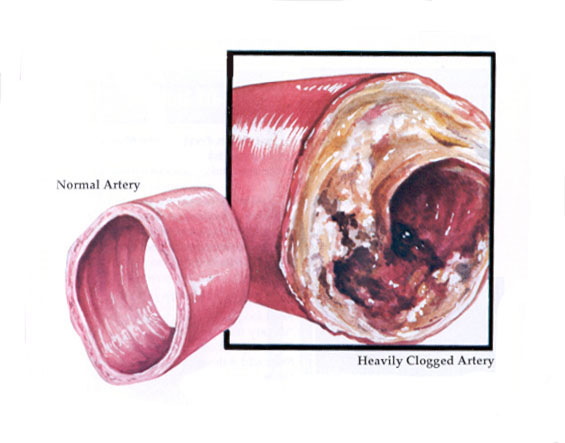 graphic of artery clogged with atherosclerosis