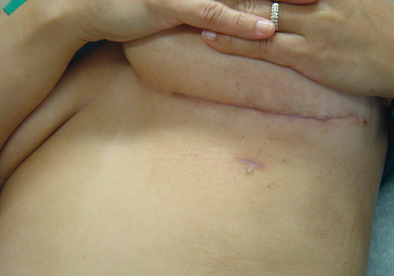 a woman's chest post open heart bypass surgery